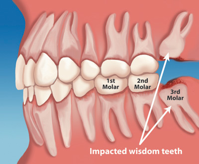 Removal of Wisdom Tooth